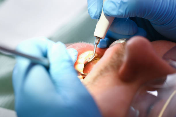 Best Knocked-Out Tooth Emergency  in Lla Lla, WA