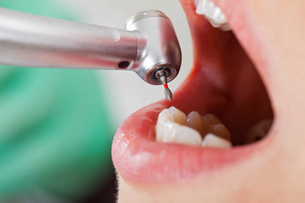 Urgent Tooth Repair in WA
